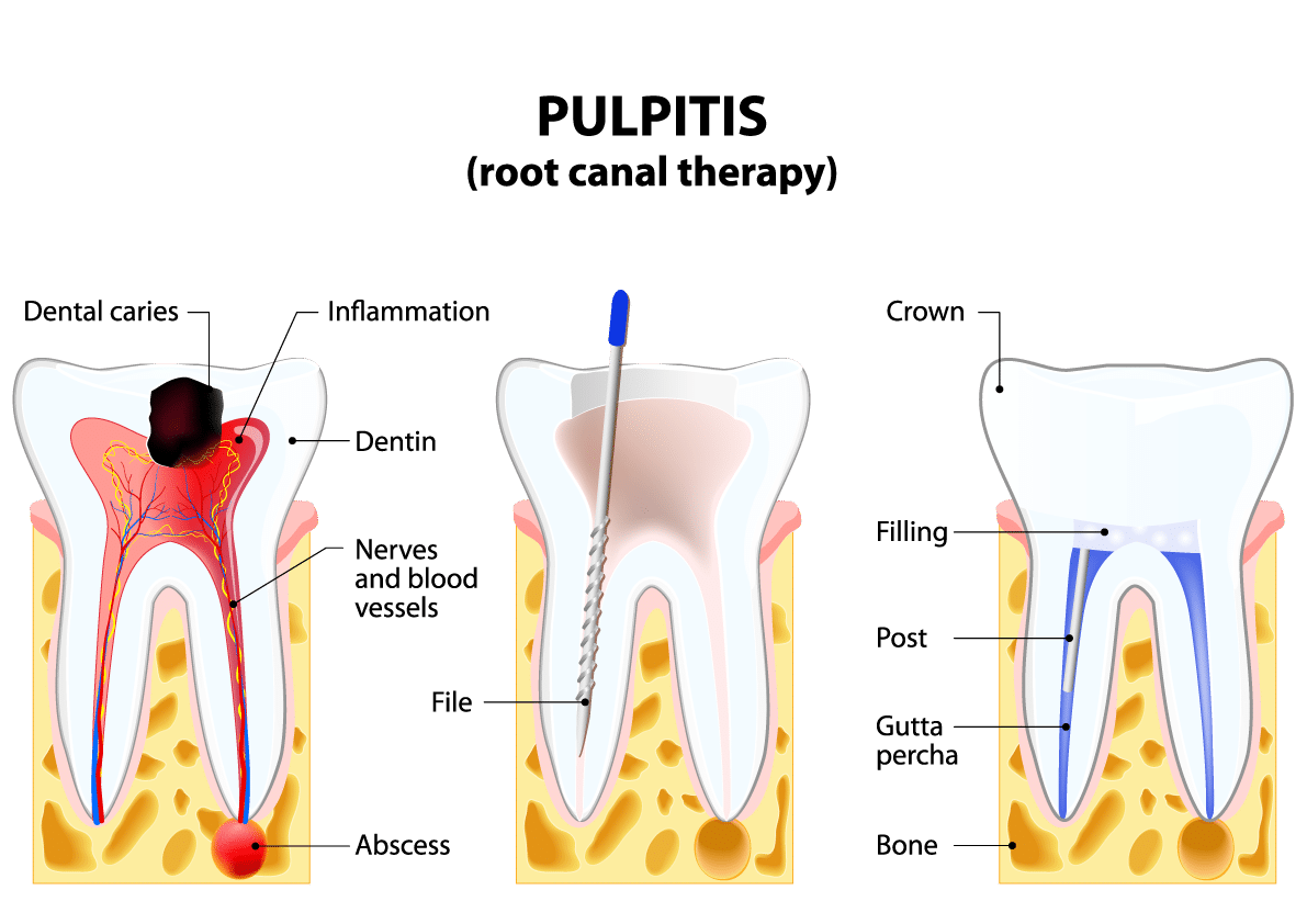 Root Canal, performed by the Dr. Saferin, in bestsmiles Dentist westhartford, CT