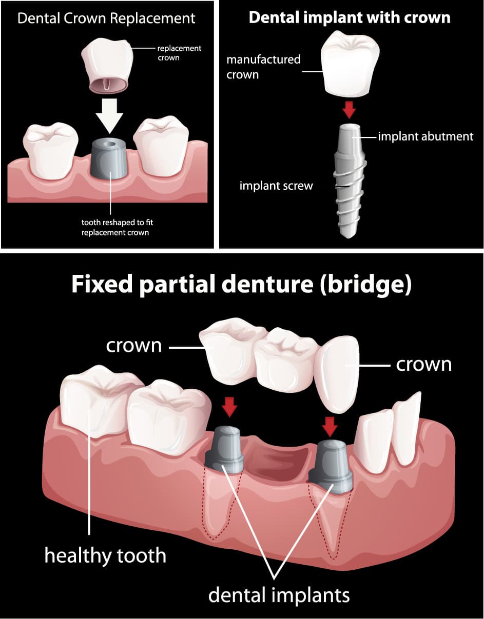 Tooth Implant, Dr. Saferin, in bestsmiles Dentist west hartford, CT