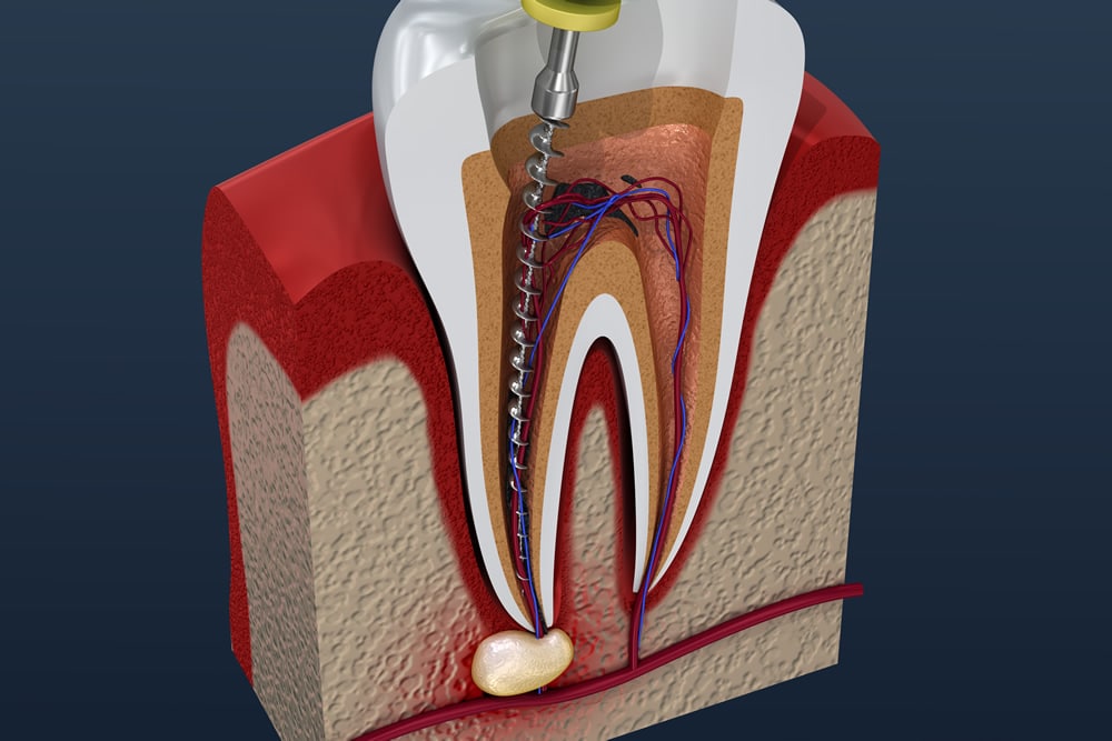 Can You Get More Than One Root Canal On The Same Tooth